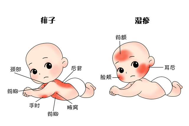 湿疹痱子傻傻分不清楚？手把手教你认清宝宝